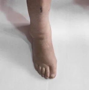 Edema