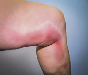 varicoflebitis