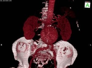 Aneurisma de Aorta