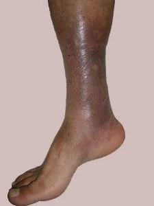 lipodermatoesclerosis