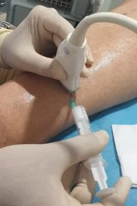 Escleroterapia