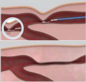 Adhesivo para varices